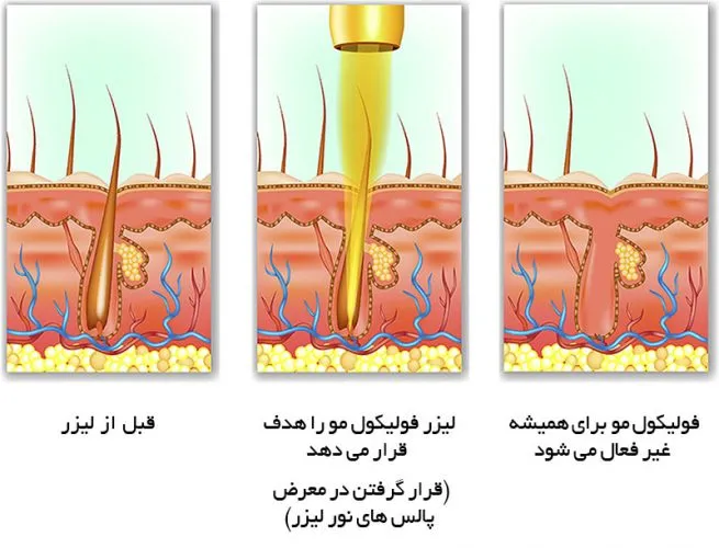 اینفوگرافی لیزر مو
