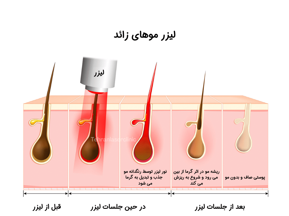 دستگاه لیزر موهای زائد - نحوه انجام لیزر موهای زائد 