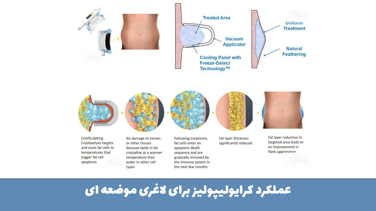 عملکرد کرایولیپولیز برای لاغری موضعه ای