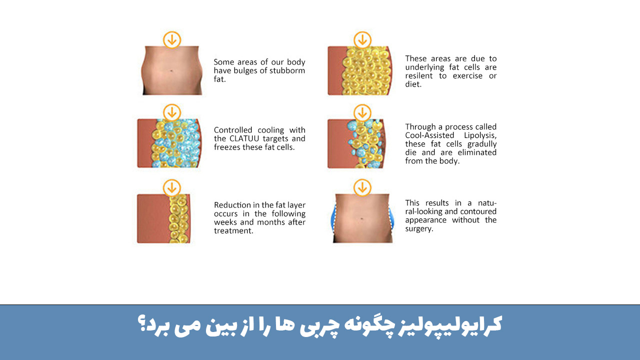 کرایولیپولیز چگونه چربی ها را از بین می برد؟