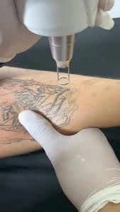 لیزر کیوسوئیچ برای پاک کردن تتو