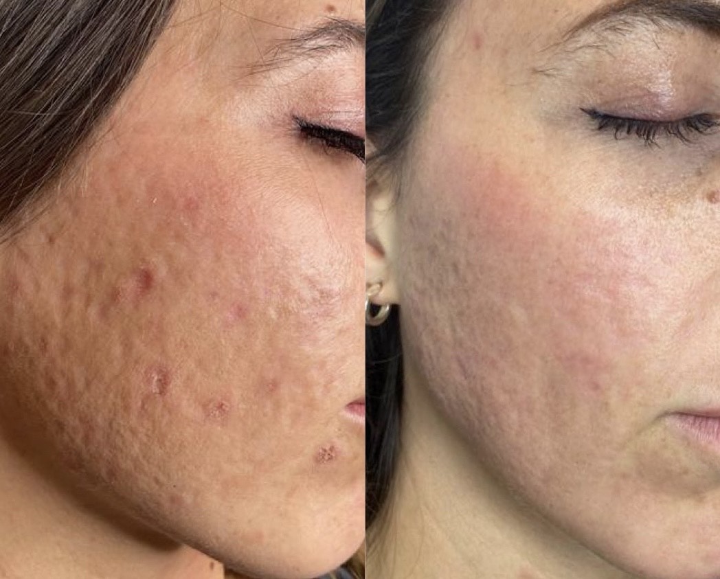 درمانجای جوش با co2