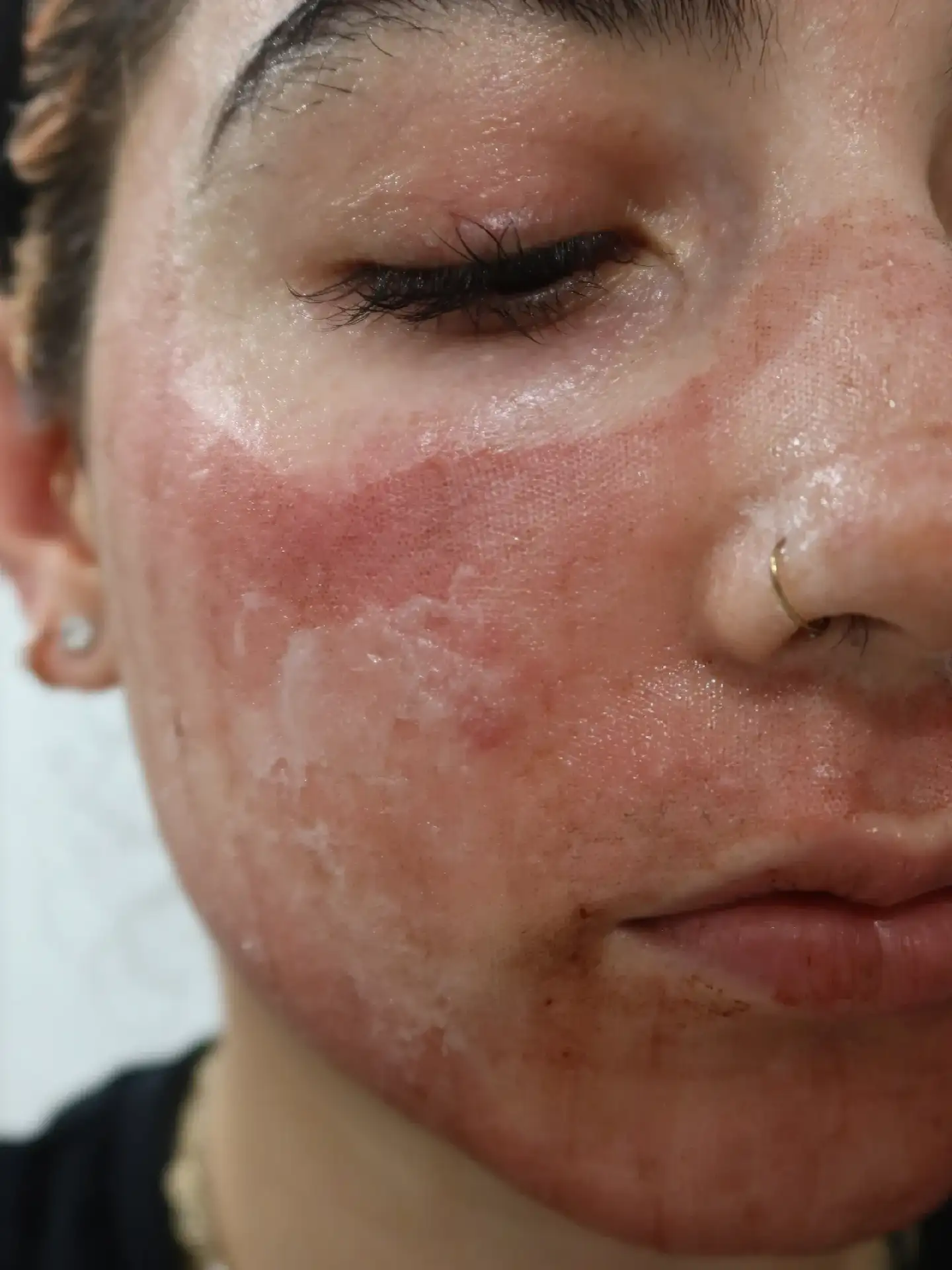 درمان اسکار با لیزر co2 فرکشنال