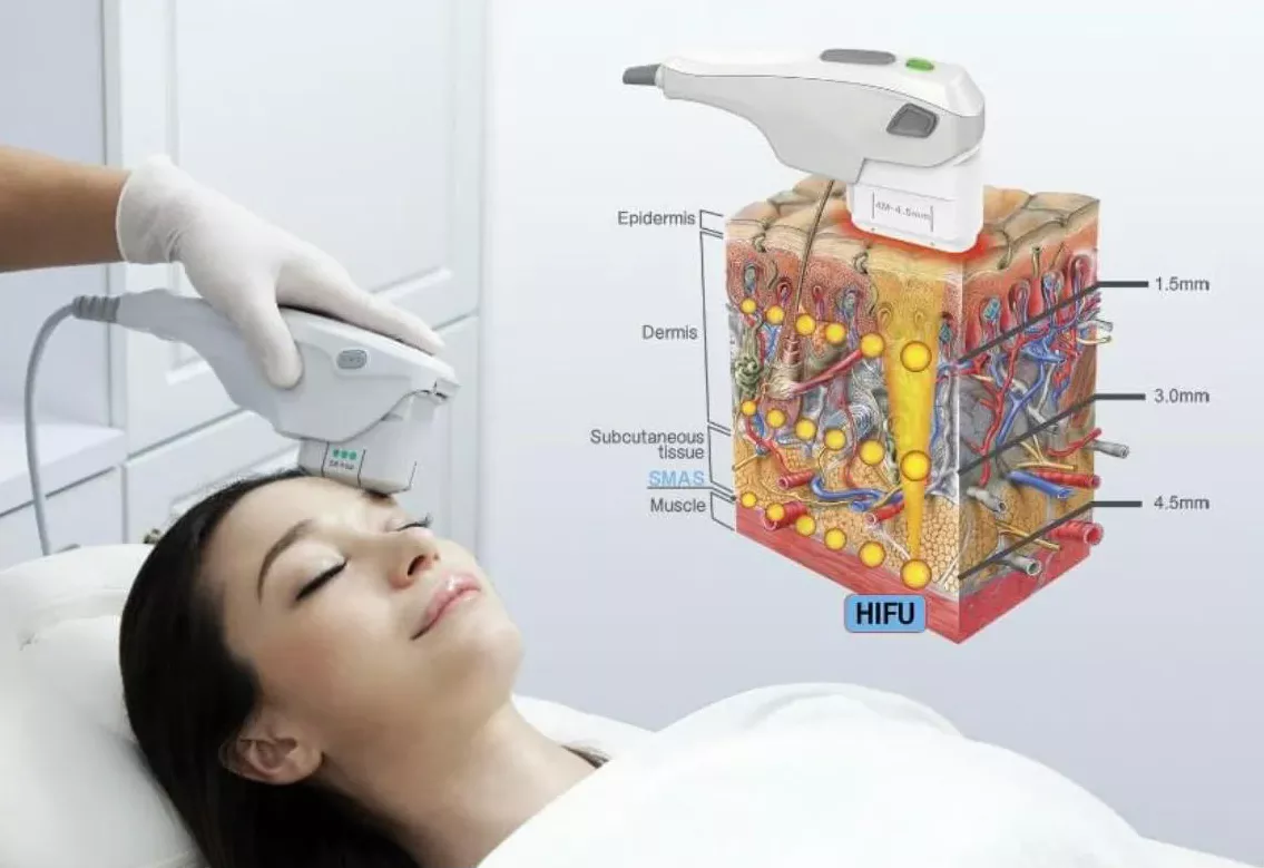 سفت شدن پوست با هایفو