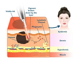 چرا لیزر کیوسوئیچ