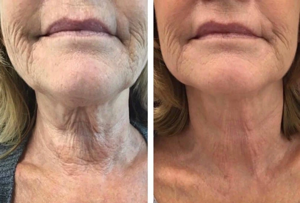 کاهش چین و چروک