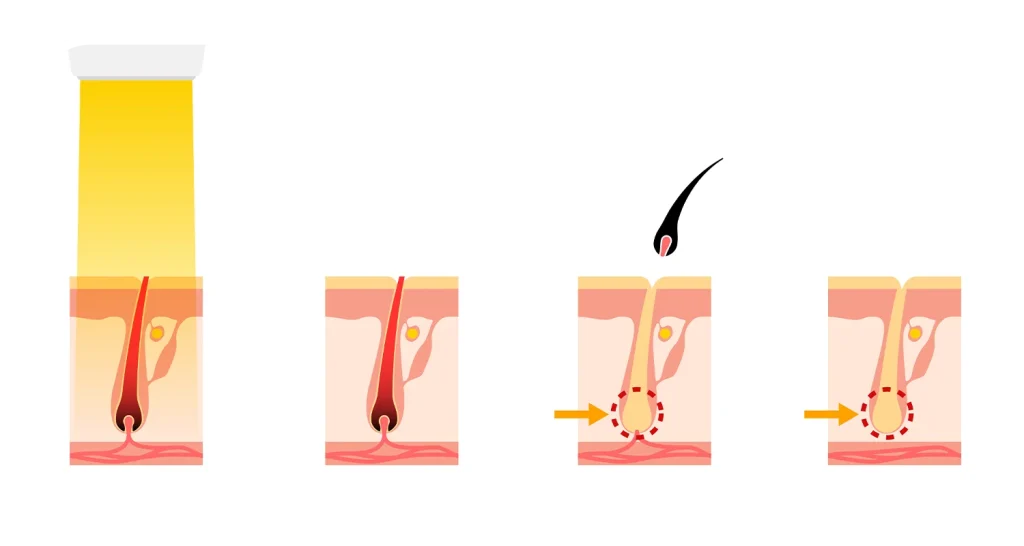 بهترین دستگاه لیزر برای موهای ضخیم