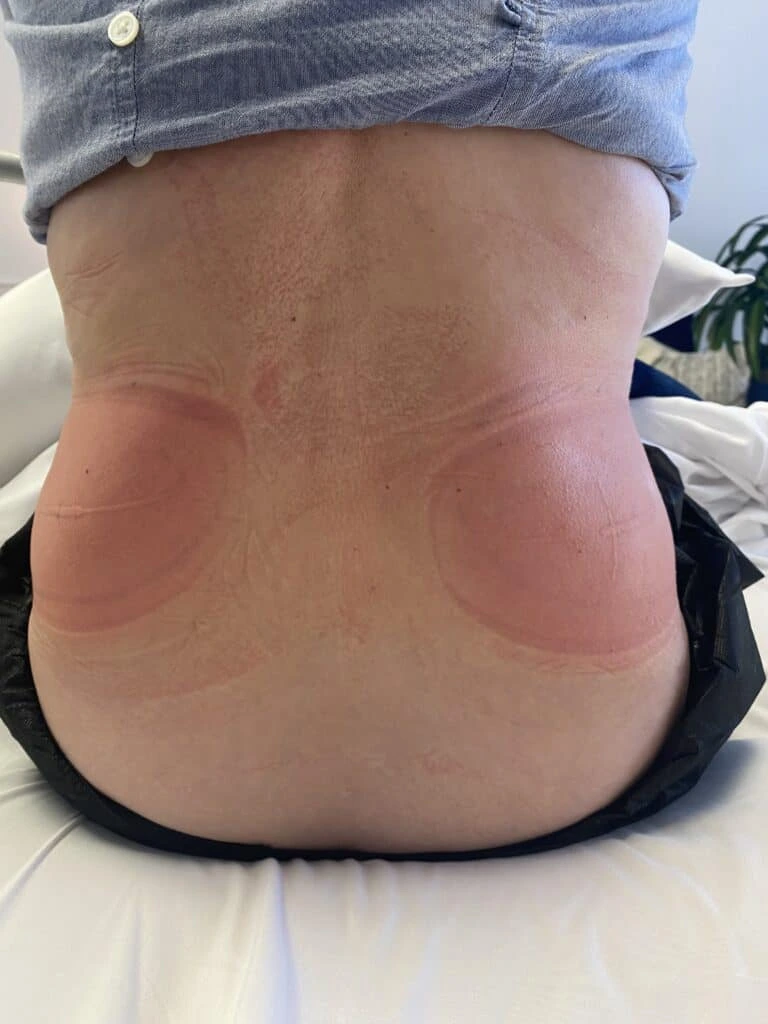 کبودی و قرمزی