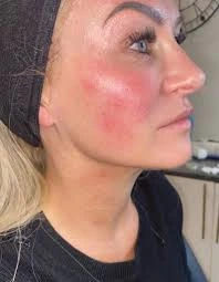 عوارض هایفوتراپی