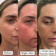 مراحل هایفوتراپی