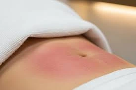 قرمزی و تورم